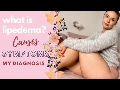 What is Lipedema? Causes, Symptoms and My Diagnosis