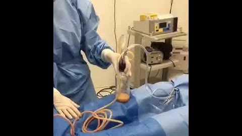Para onde vai a gordura retirada na Lipoaspiração? Cirurgia Plástica Porto Alegre - André Valiati