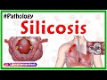 Silicosis miners phthisis grinders asthma  etiology  pathophysiology   diagnosis treatment