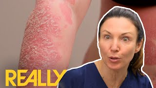 This Is The Worst Case Of Psoriasis That Dr Emma Has Ever Seen! | The Bad Skin Clinic