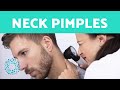 Neck Pimples - Why Do We Get PIMPLES on the Neck?