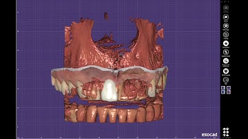 exocad exoplan mit Guide Creator