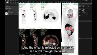PET-CT data from Canon Medical Systems in Hermia Software