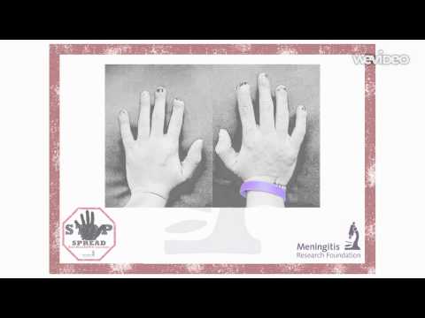 #StopTheSpread Warning to Youngsters About New Strain of Meningitis