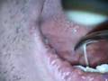 Lingual Frenectomy with Erbium Laser