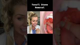 Big juicy tonsil stone removal! #tonsilstones #dentist #tonsils