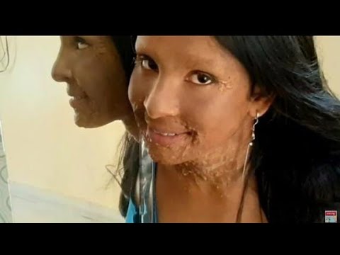 #छपाक़ #chhapaakDeepika padukon's acid attack look from chhapaak movie makeup tutorial...🙏
