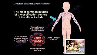 Common Pediatric Elbow Fractures - Everything You Need To Know - Dr. Nabil Ebraheim