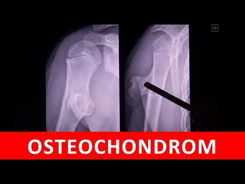 Osteochondrom - MRT CT und Röntgen Darstellung - by Radiologie TV