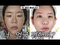 볼패임•볼꺼짐 시술 모음집 Top5 땅콩형 얼굴 탈출 (엠페이스?써마지?볼필러?쥬베룩?지방이식?실리프팅?인모드?) 내 황금비율 얼굴 점수는?