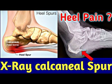 calcaneal spur xray