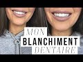 COMMENT J'AI BLANCHI MES DENTS ? MON BLANCHIMENT DENTAIRE