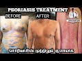 Psoriasis treatment in tamil    radha homeo clinic
