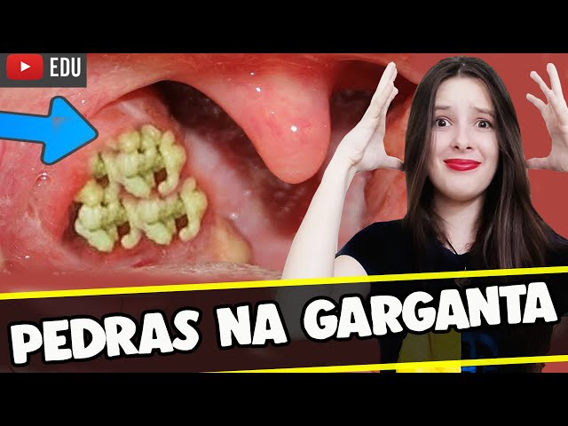 Pedras nas amígdalas: como aparecem e como removê-las em casa