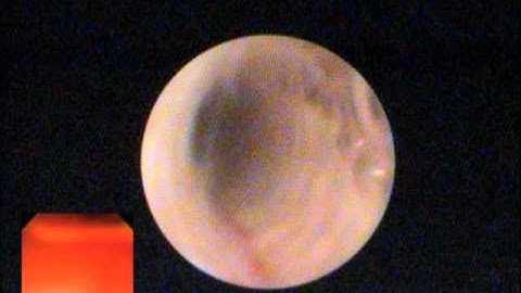 cholangioscopy via sphinctertome