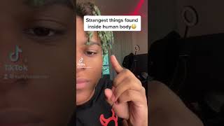Strangest things found inside human body😳 #shorts