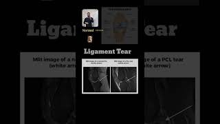 MRI Knee – 5 Common Pathologies Every Radiology Student Should Know . #radiologyeducation