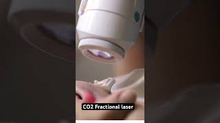 CO2 fractional laser-Skin Resurfacing skin viral shorts