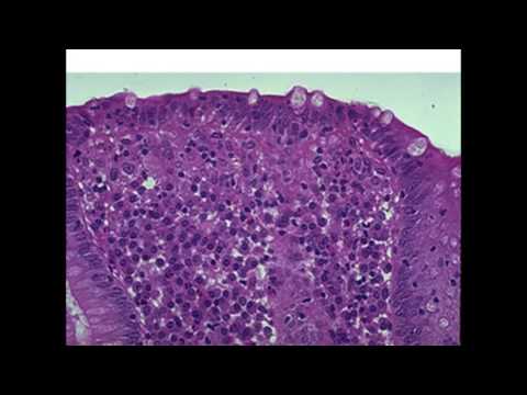 Microscopic Colitis: Diagnosis and Treatment