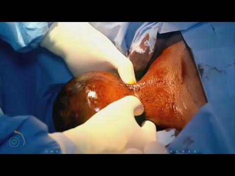 مشاكل الختان أدت الى ورم ضخم على البظر