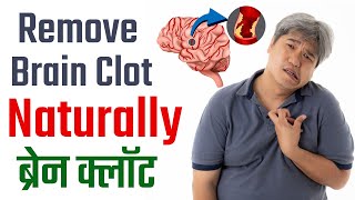 Remove Brain Clot Naturally | ब्रेन क्लॉट | Brain Stroke Treatment