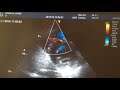 Coronary artery to right ventricle fistula