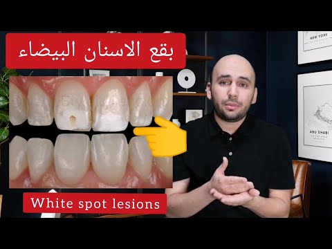 تسوس الأسنان الأمامية الأبيض البقع البيضاء في الاسنان بدون برد الاسنان الطبيعية