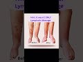 What reduced this Leg swelling?