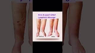 What reduced this Leg swelling?