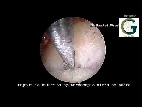 Patient Info: Uterine Septum correction surgery by hysteroscopy