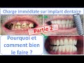 Dents fixes sur implant - Charge immédiate - Part 2