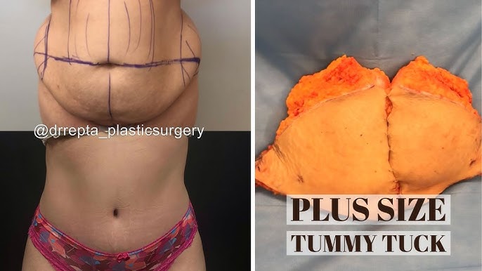 Dr Repta Performs a Plus Size Tummy Tuck 