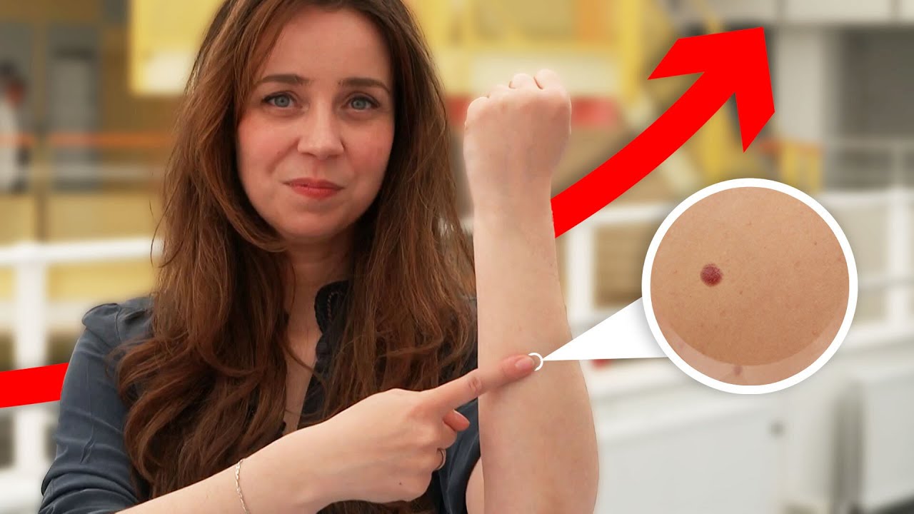 Zo herken je huidkanker