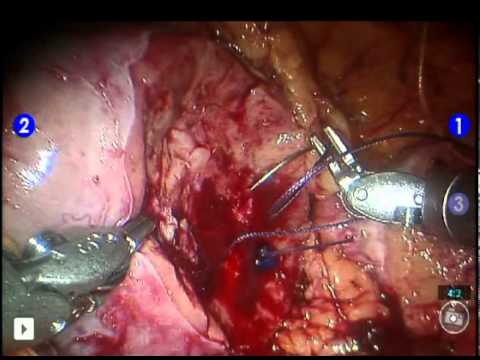 Robotic Partial Nephrectomy - daVinci Partial Nephrectomy for Kidney Cancer