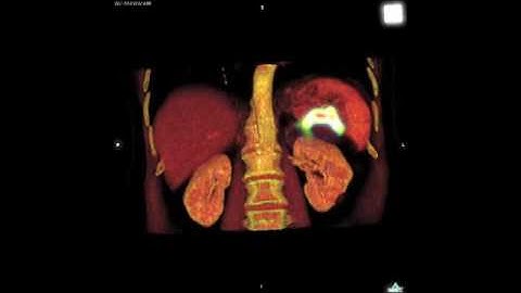 PET-CT e Osirix MD Anvisa