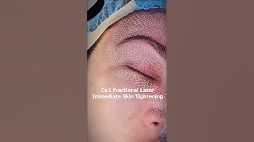 Say Goodbye to Wrinkles CO2 Laser Lift ✨👁️ #flawlessskin