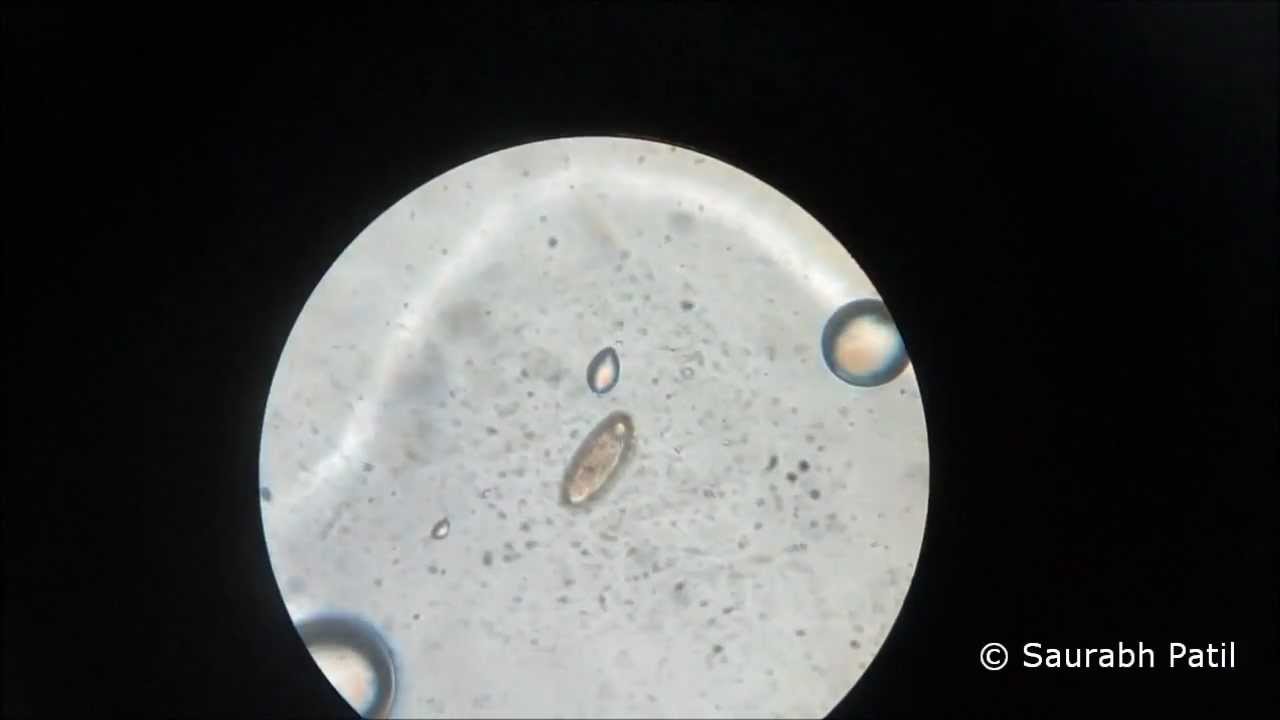 enterobius vermicularis yumurtasi goruldu