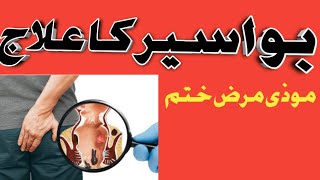 Bawaseer ka ilaj urdu|piles hemorrhoids treatment in home #desiilaj #bawaseerkailaj #bawaseer #pile