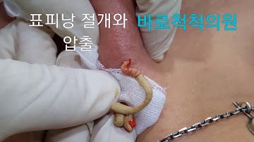 표피낭(epidermal cyst) 뿌리 뽑기