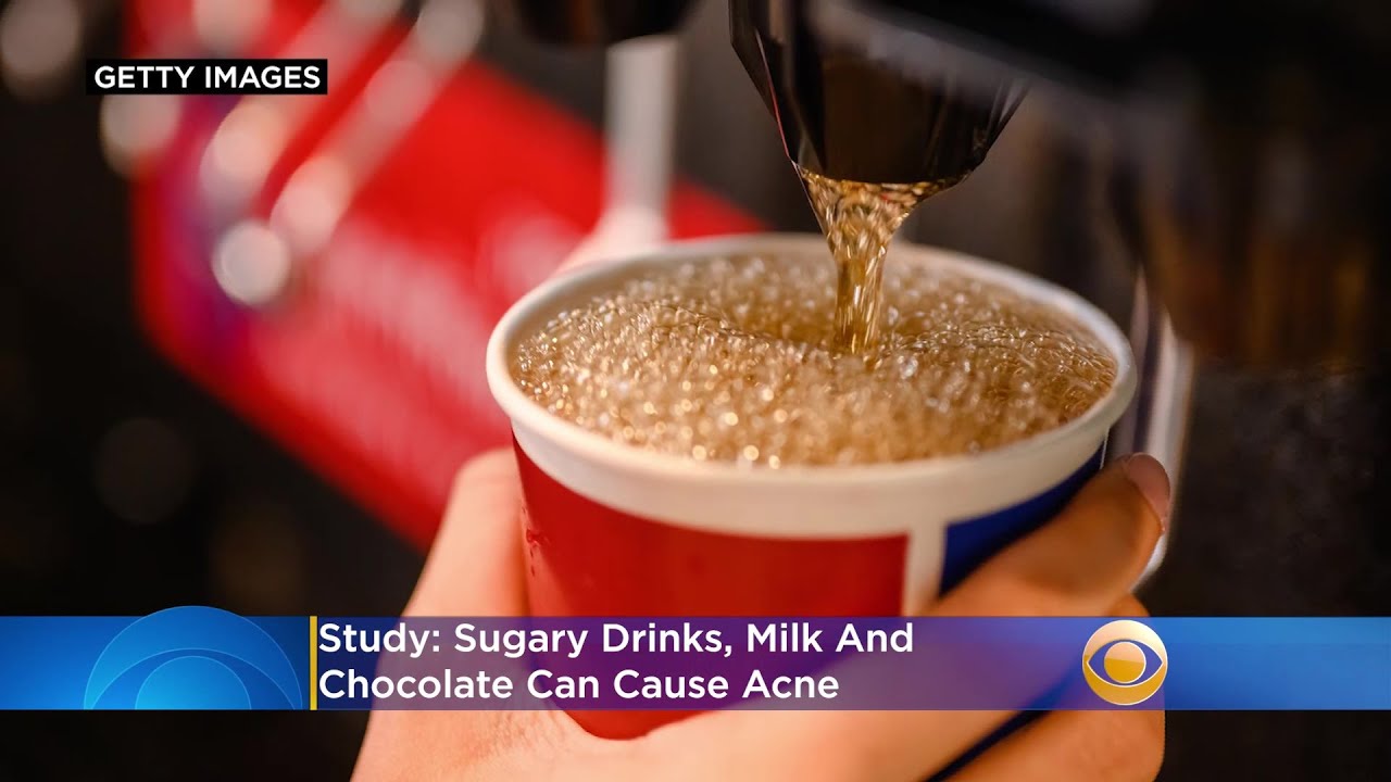 Study: Sugary Drinks, Milk And Chocolate Can Cause Acne - YouTube