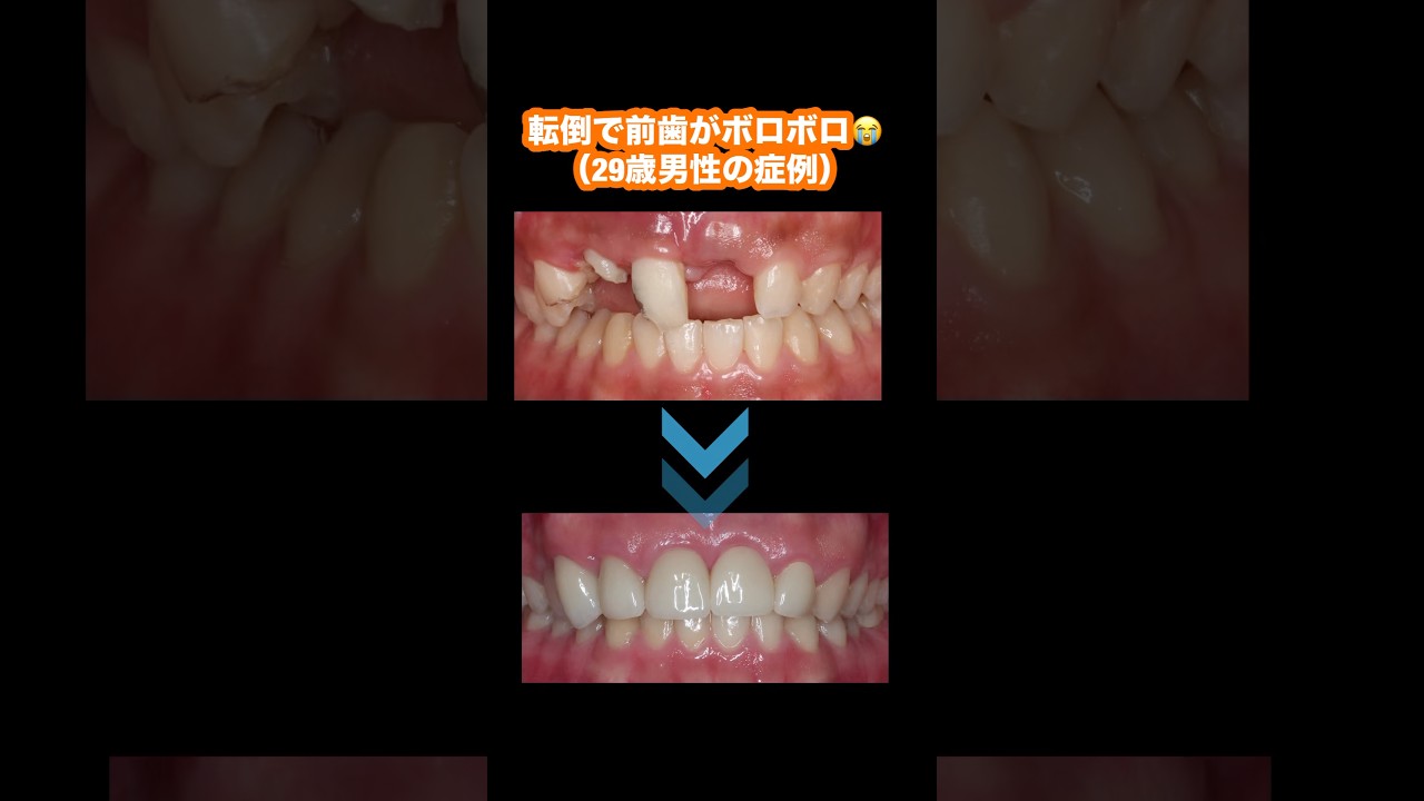 A dramatic before-and-after of a 29-year-old man whose front teeth