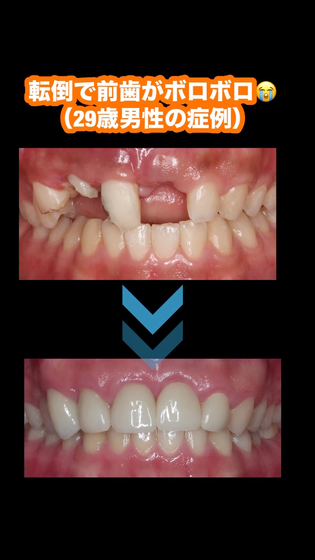 A dramatic before-and-after of a 29-year-old man whose front teeth