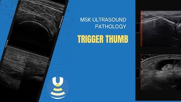 Trigger thumb demonstrated on ultrasound