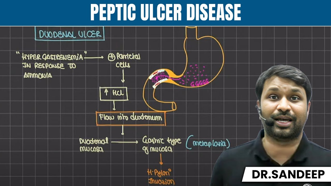 Peptic Ulcer Disease | Surgery | Bailey learned with Dr. Sandeep | PW MedEd
