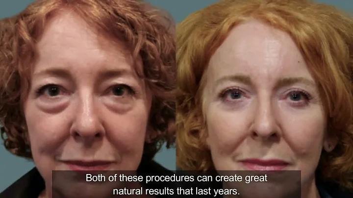 Dr. Joseph Discusses Lower Eyelid Surgery | Lower ...