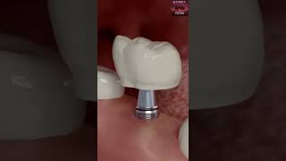 شاهد كيف تتم  زراعة الأسنان????Dental Implant Procedure Explained Step by Step