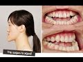 [id hospital review] let me in china, Orthognathic surgery before and after