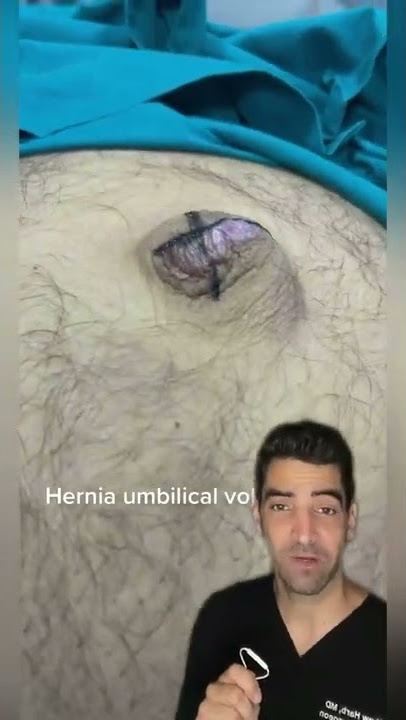 Hernia Umbilikalis