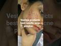 vestige products best results acne pimples #youtube #shortvideo