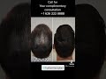 Before and After FUE Hair Transplant Repair 12 months post procedure Los Angeles, Beverly Hills area